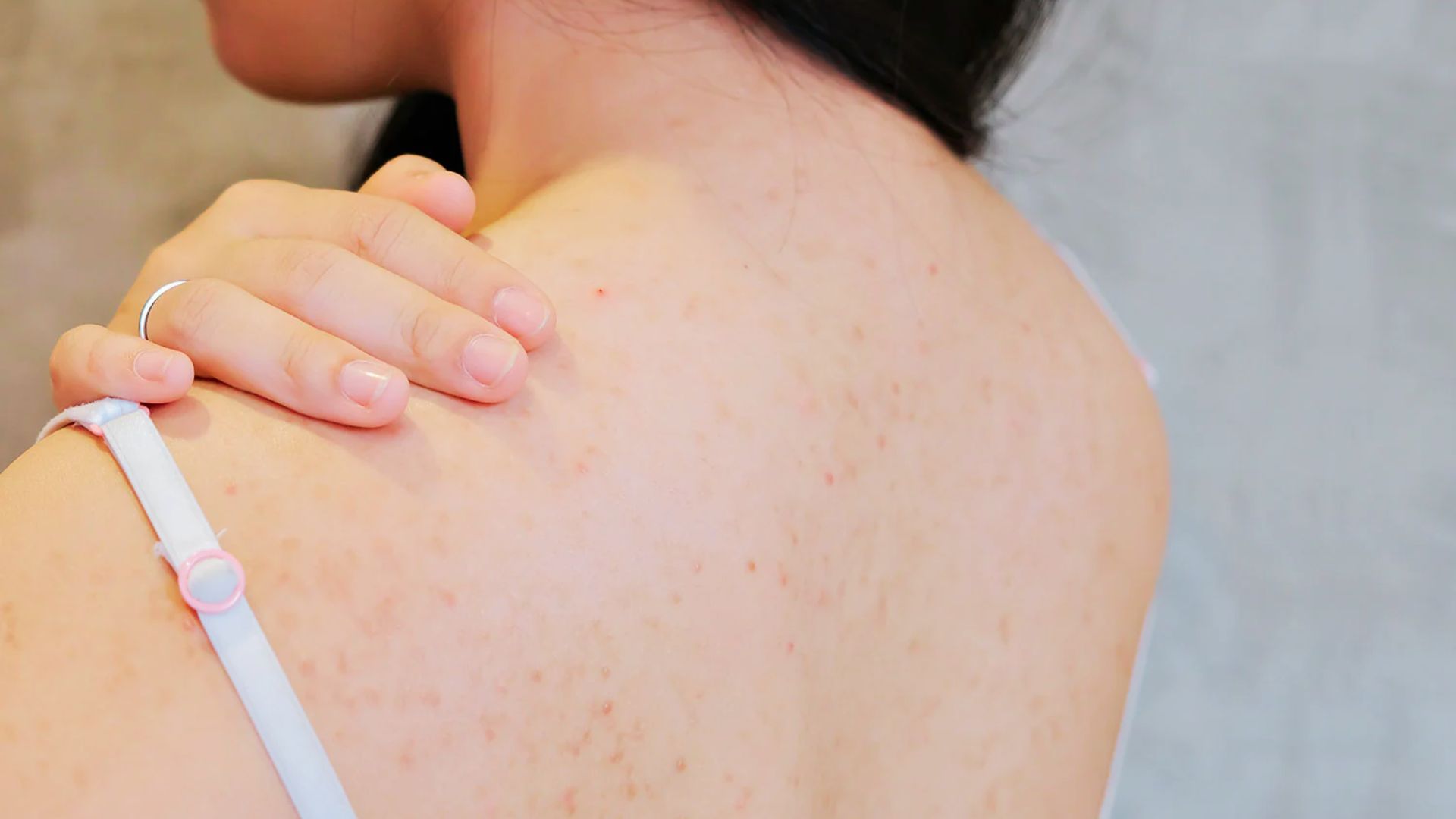 Woman with Back acne and breakouts after using loofah, showing how bacteria transfer can affect skin.
