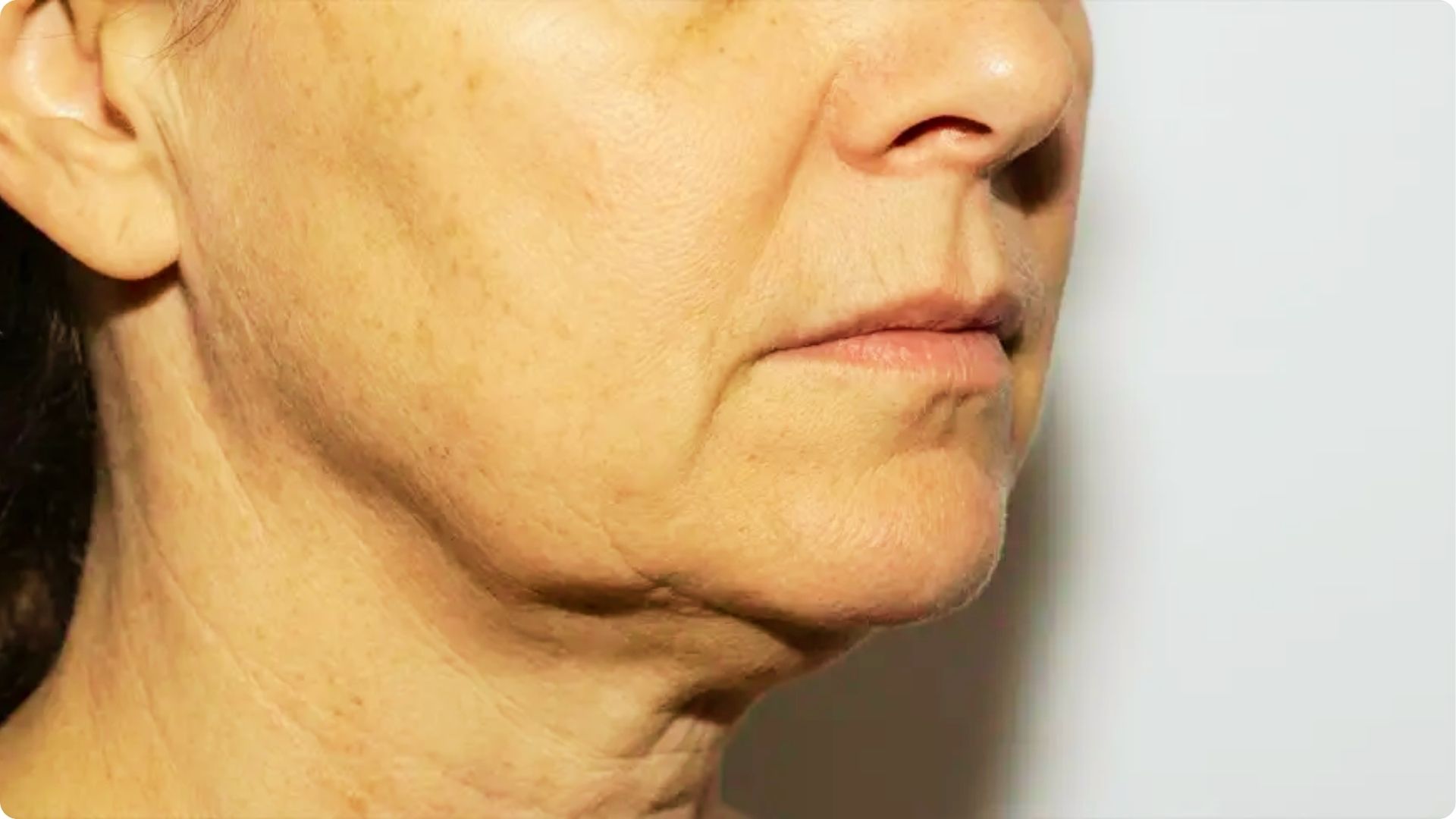 Side profile of a woman's lower face and neck showing sagging skin and prominent jowls along the jaw.