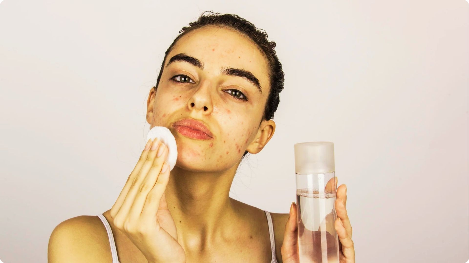 Woman with acne and blemishes using a cotton pad and toner on her face while holding a bottle
