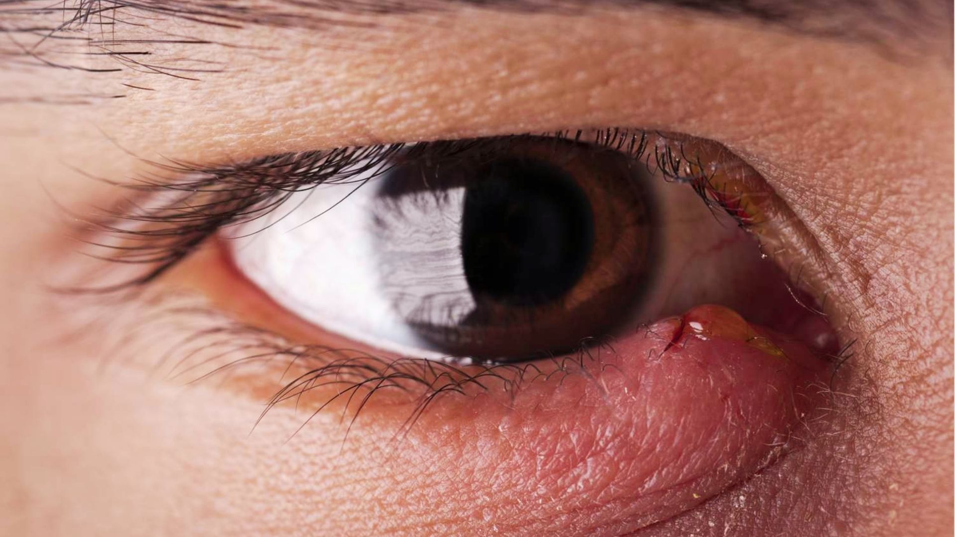 Close-up of a person showing a small bump under the eye