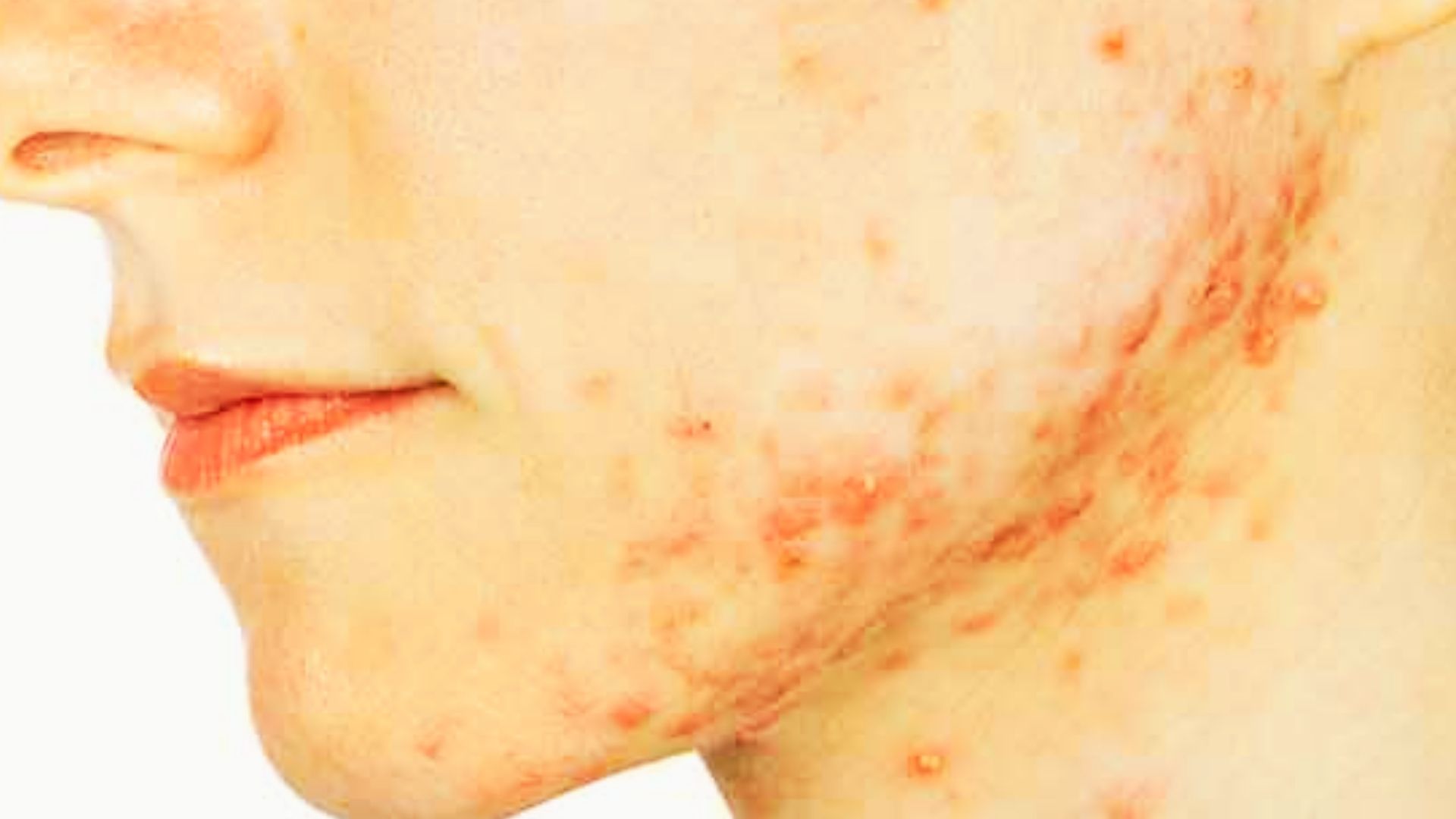 Side profile closeup of woman's jawline and neck with red inflamed acne and pimples visible