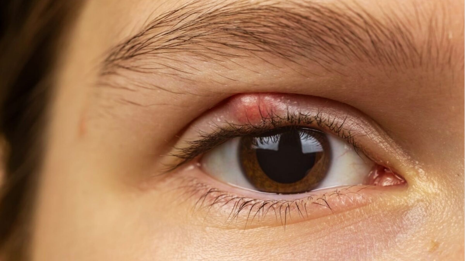 Person applying fresh aloe vera gel gently under the eye to soothe and reduce a small bump.
