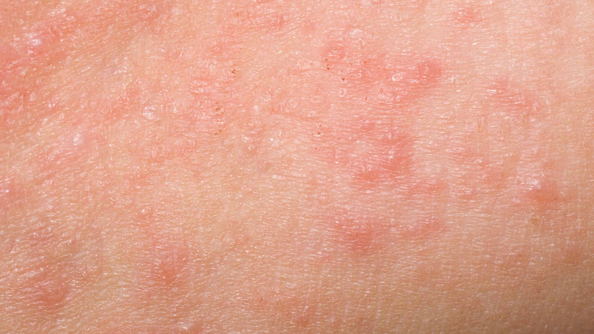 Woman noticing skin redness after showering with loofah, showing irritation caused by dirty or rough exfoliation.