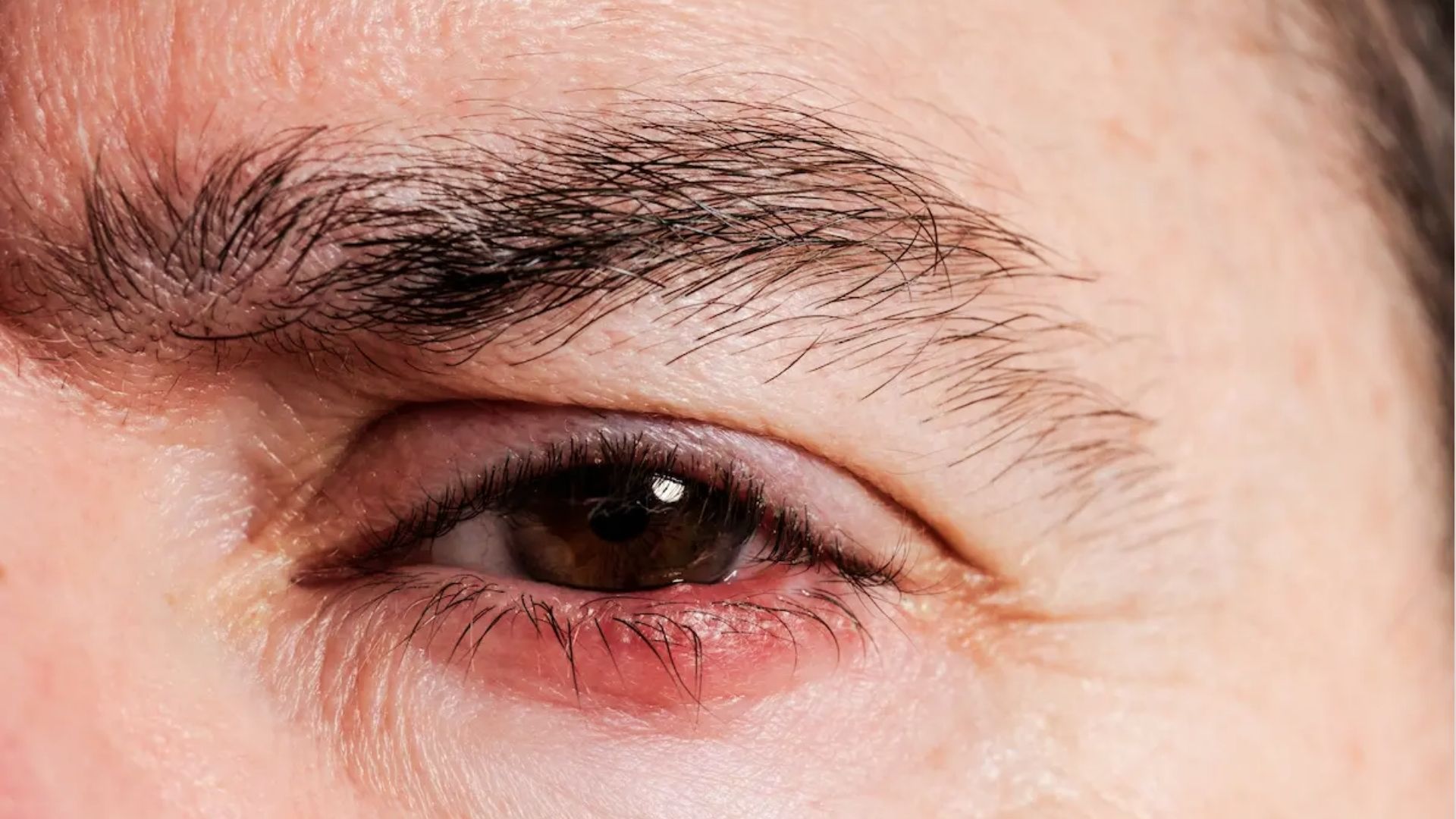 Person applying diluted tea tree oil with a cotton swab to a small bump under the eye.