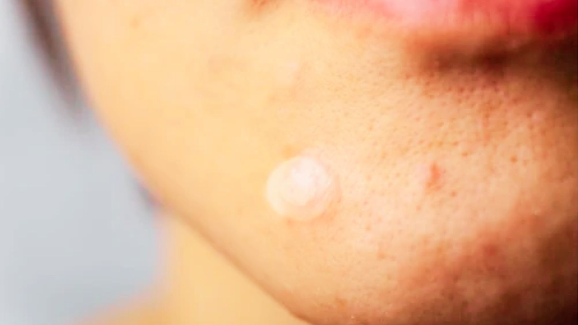 Hydrocolloid pimple patch covering inflamed cystic acne with realistic skincare-focused close-up facial skin texture