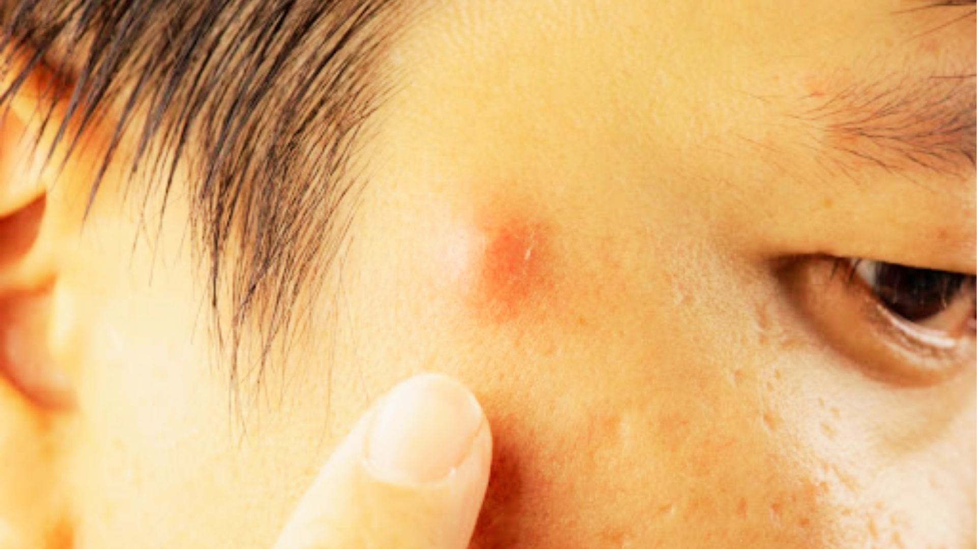 Closeup of person pointing to large red inflamed cystic pimple on temple near hairline