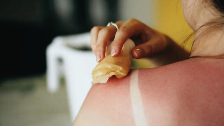 Woman applies damp cloth to severely sunburned shoulder with tan line, soothing skin irritation using home remedy.