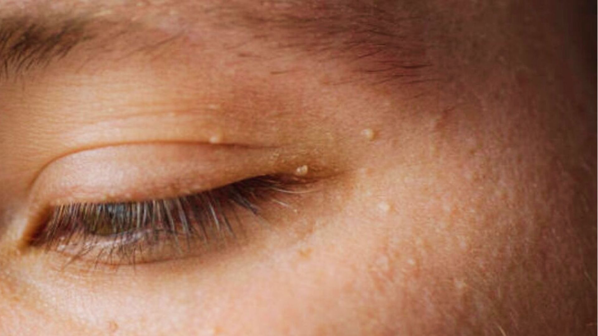 close-up of a person showing Stye Milia (White Bump Under Eye)