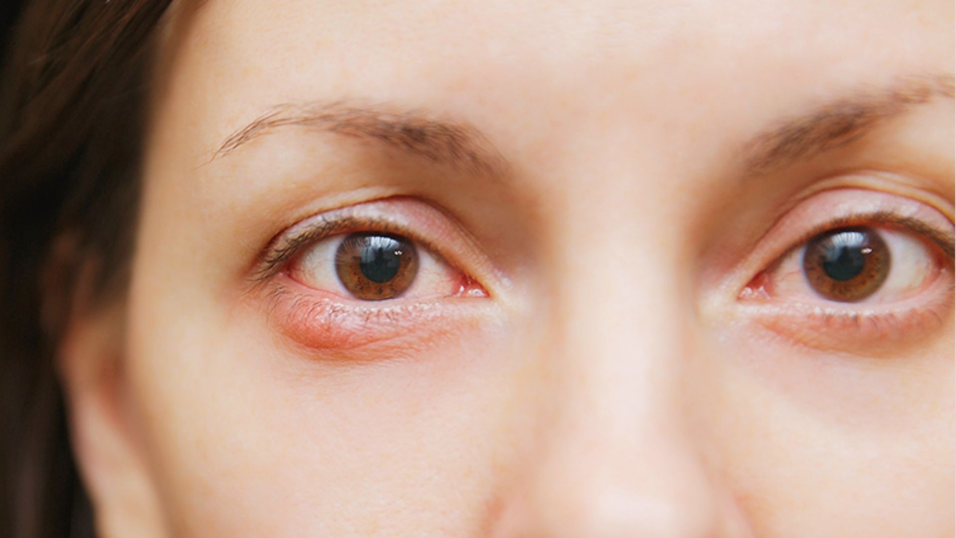 Close-up of a woman with a small bump under her eye showing an under-eye skin concern.