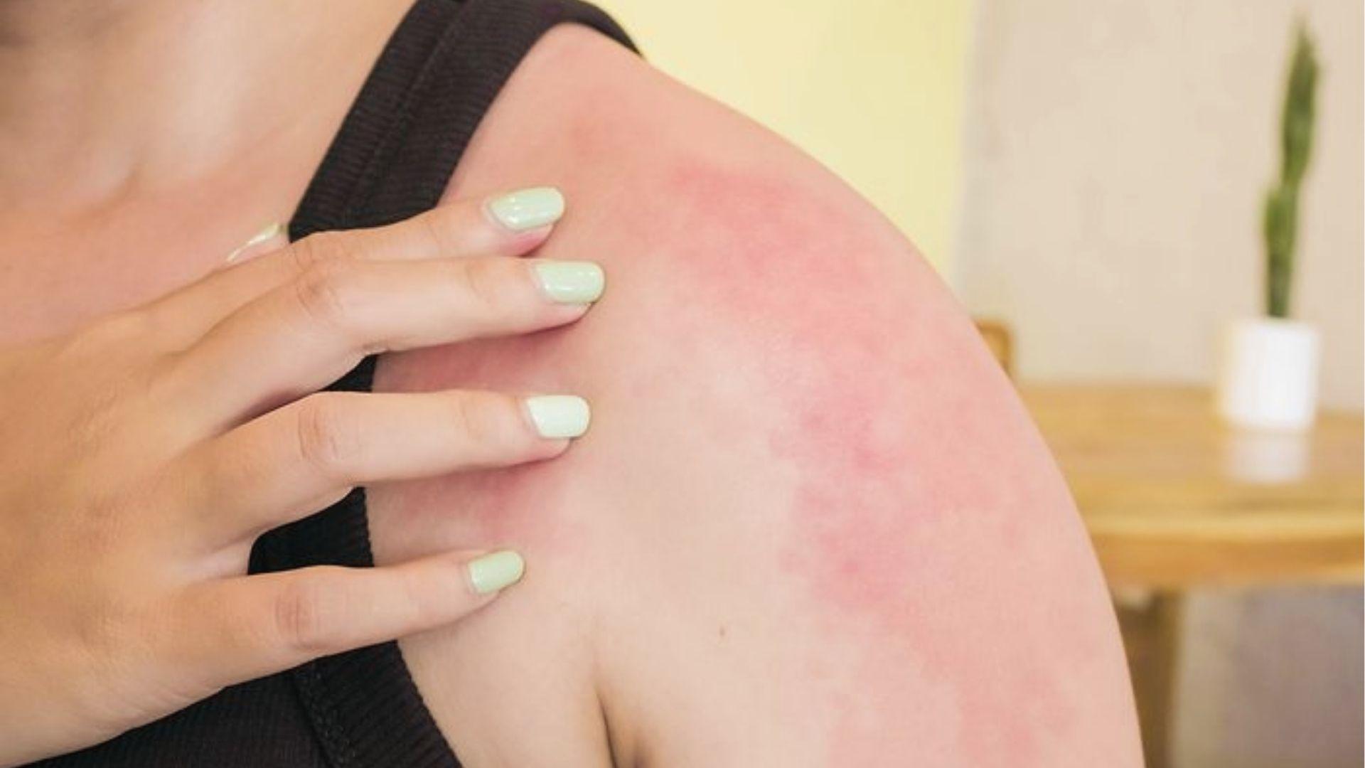 Sun poisoning triggers a painful red rash on the shoulder as a person touches inflamed skin to check damage.