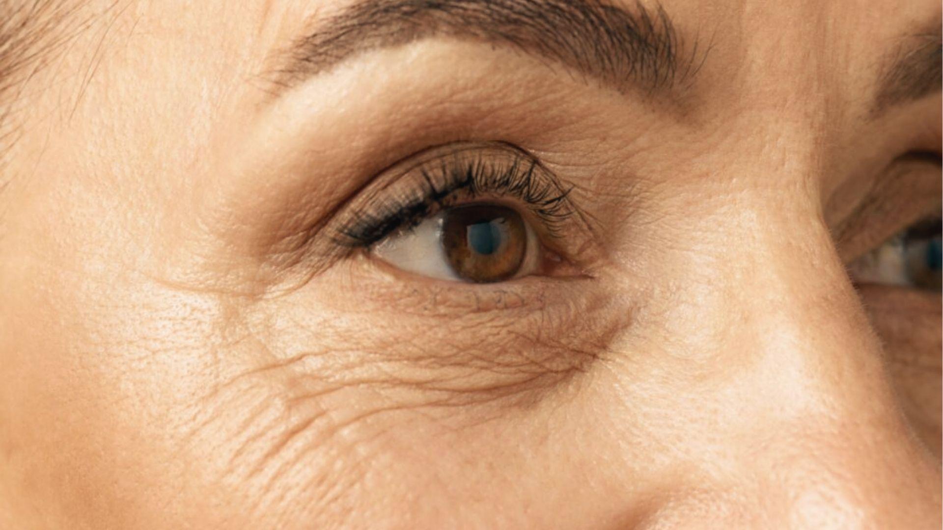 Close up of mature under eye wrinkles and fine lines needing expert targeted treatment