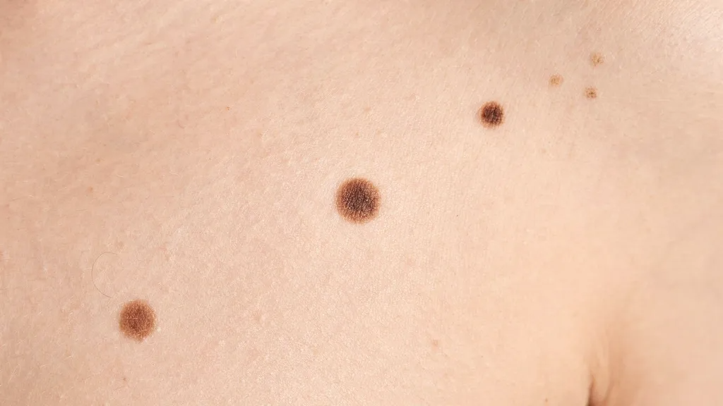 Natural skin showing common benign moles.