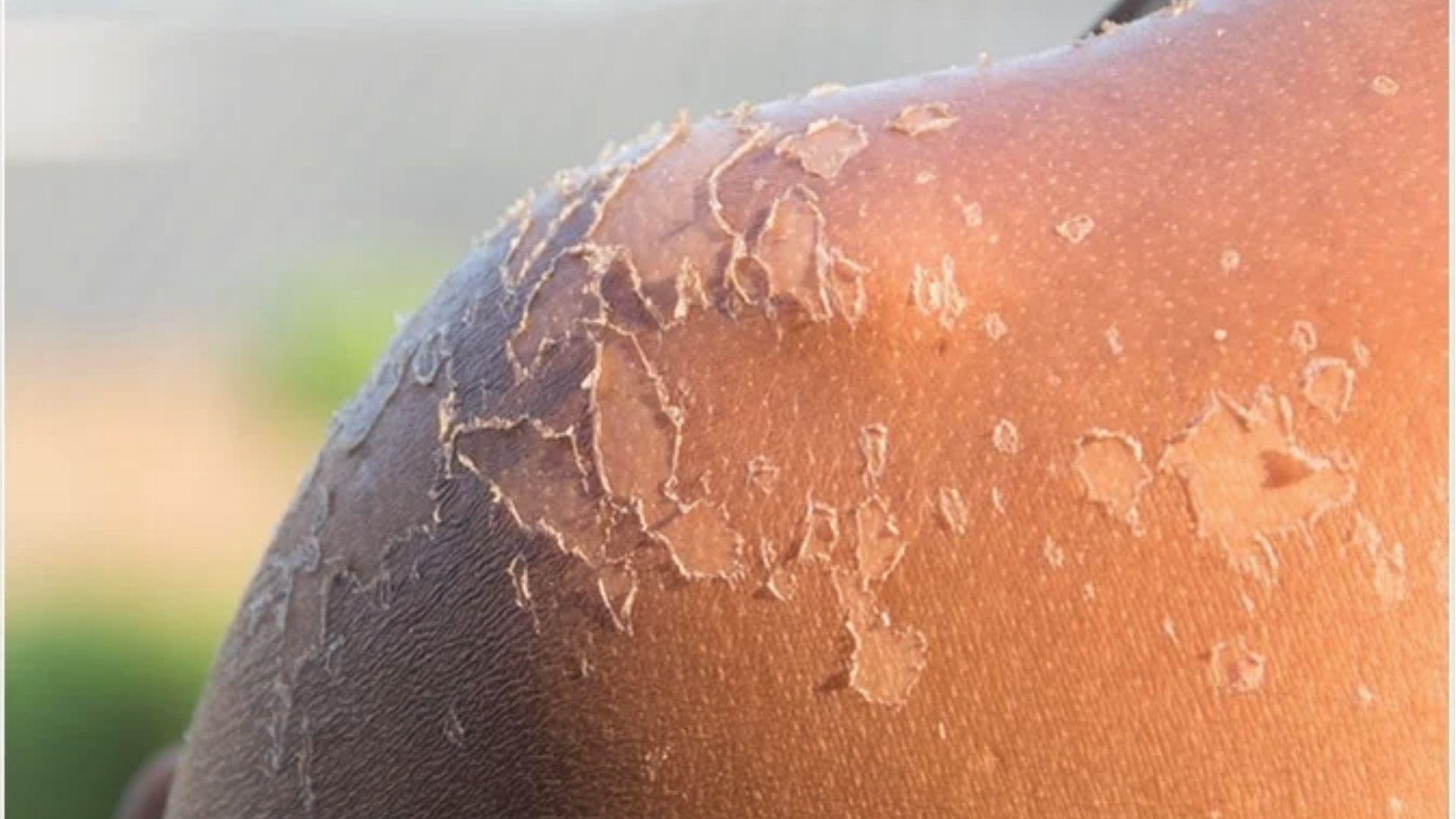 Heavy skin peeling on dark-toned shoulders reveals raw skin from intense sun poisoning.