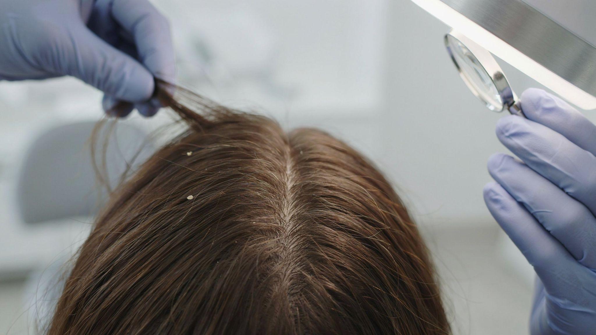 Dermatologist examining scalp health and dandruff condition in clean clinical setting