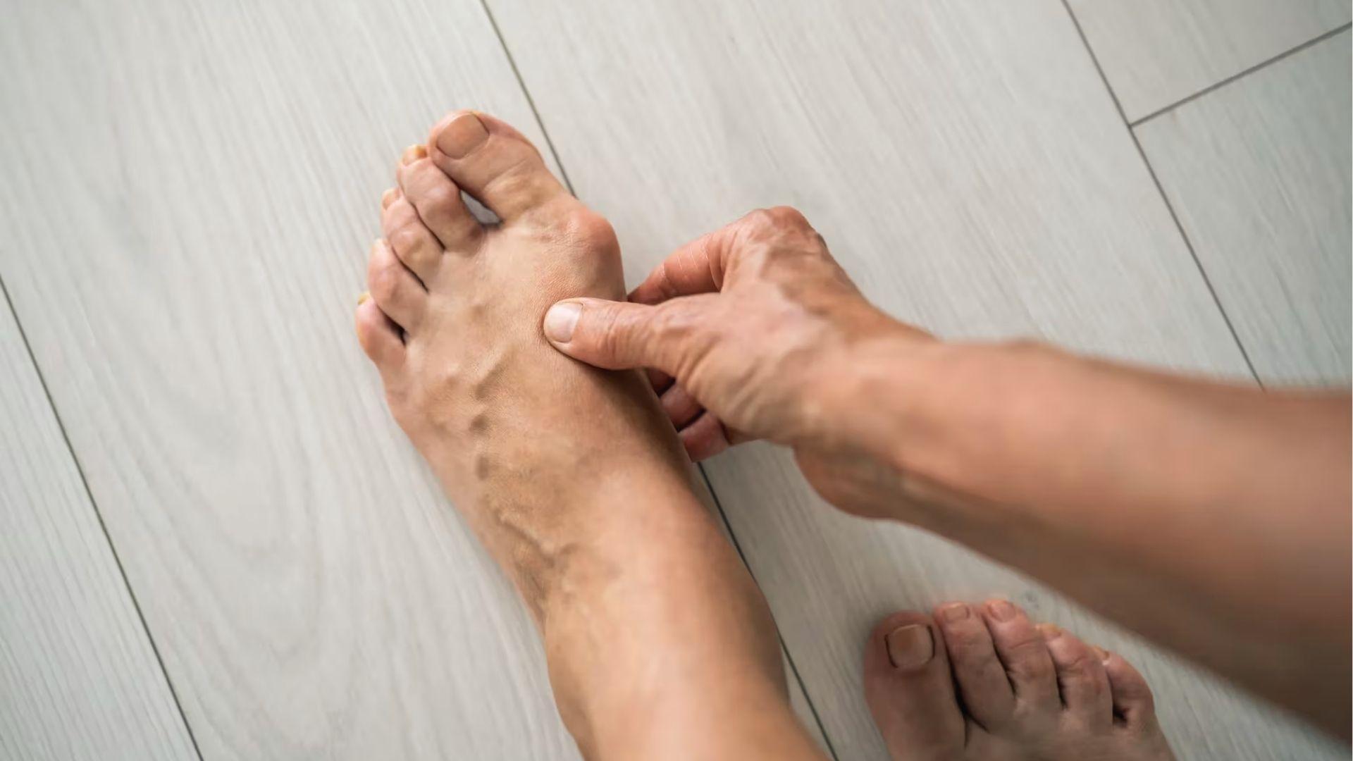 Person pointing to swollen bunion bump on big toe joint showing common bunion symptoms.