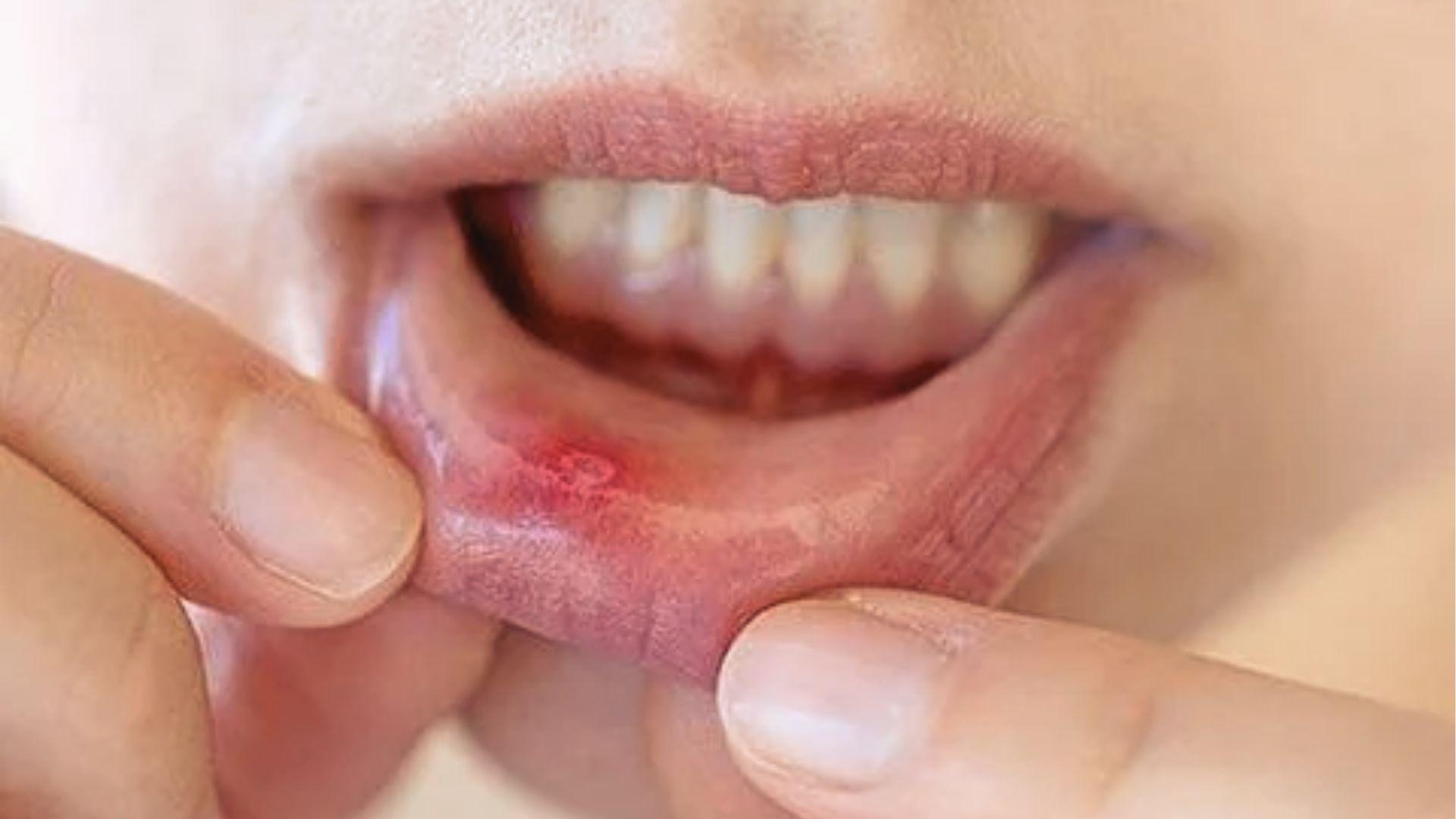 Person pulling lower lip to show a round canker sore inside mouth with red inflamed border.