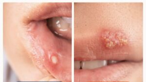 Side-by-side comparison of canker sore inside mouth versus cold sore blisters on lip surface.