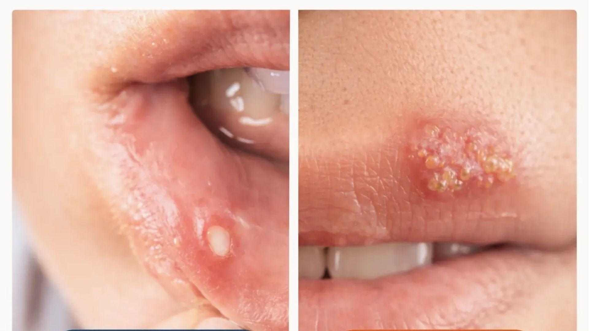 Side-by-side comparison of canker sore inside mouth versus cold sore blisters on lip surface.