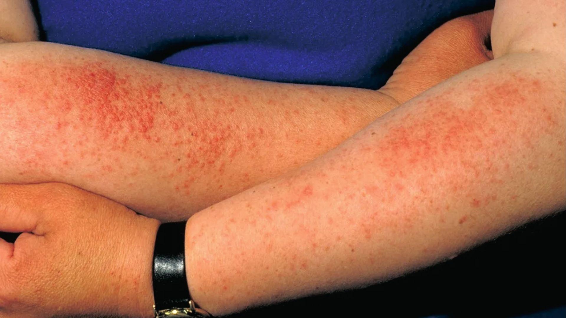 Sun poisoning rash shows red, bumpy allergic reaction across both forearms after UV overexposure.
