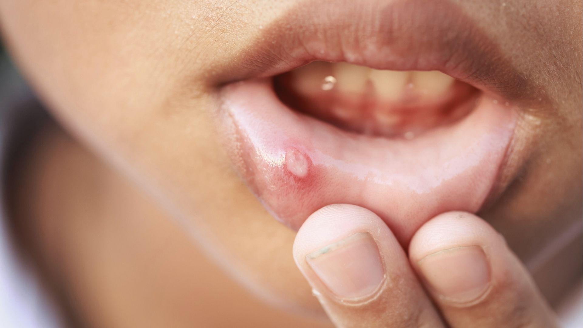Finger pulls down the lip revealing a painful white canker sore ulcer on soft inner mouth tissue.