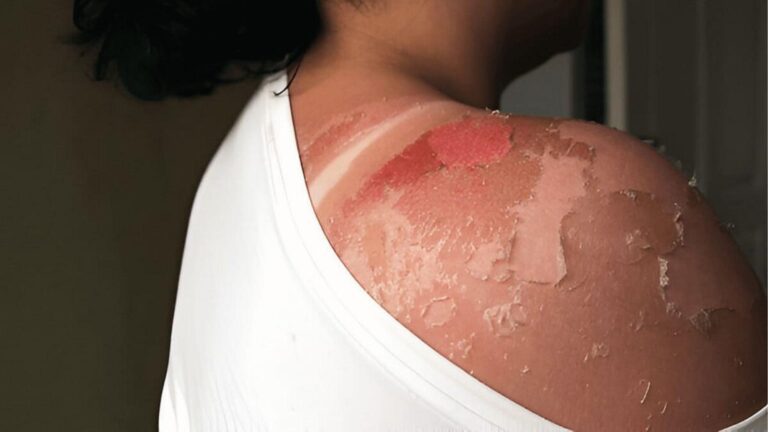 Raw red patches and widespread peeling on shoulder and back signal severe sun poisoning recovery stage.