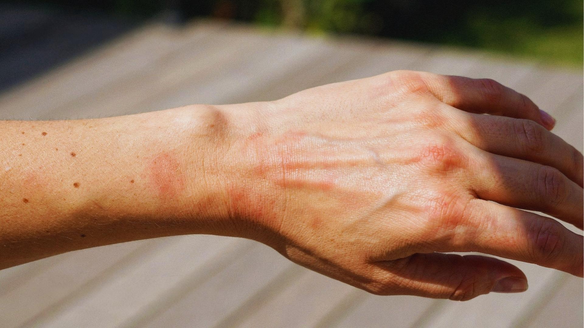 close up of human skin under sunlight demonstrating how UV rays affect melanin production and natural tanning process outdoors.