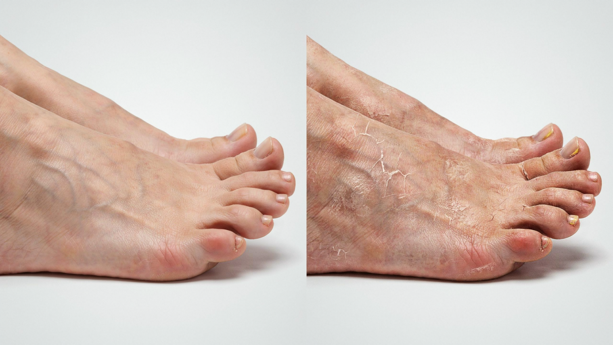 Comparison between healthy moisturized foot skin and severely affected rough foot skin.