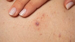 Finger pointing to a purple hard lump under skin from an ingrown hair with surrounding bumps