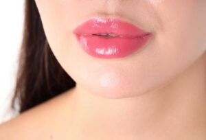 A Defined Smile With a Surgical Lip Flip