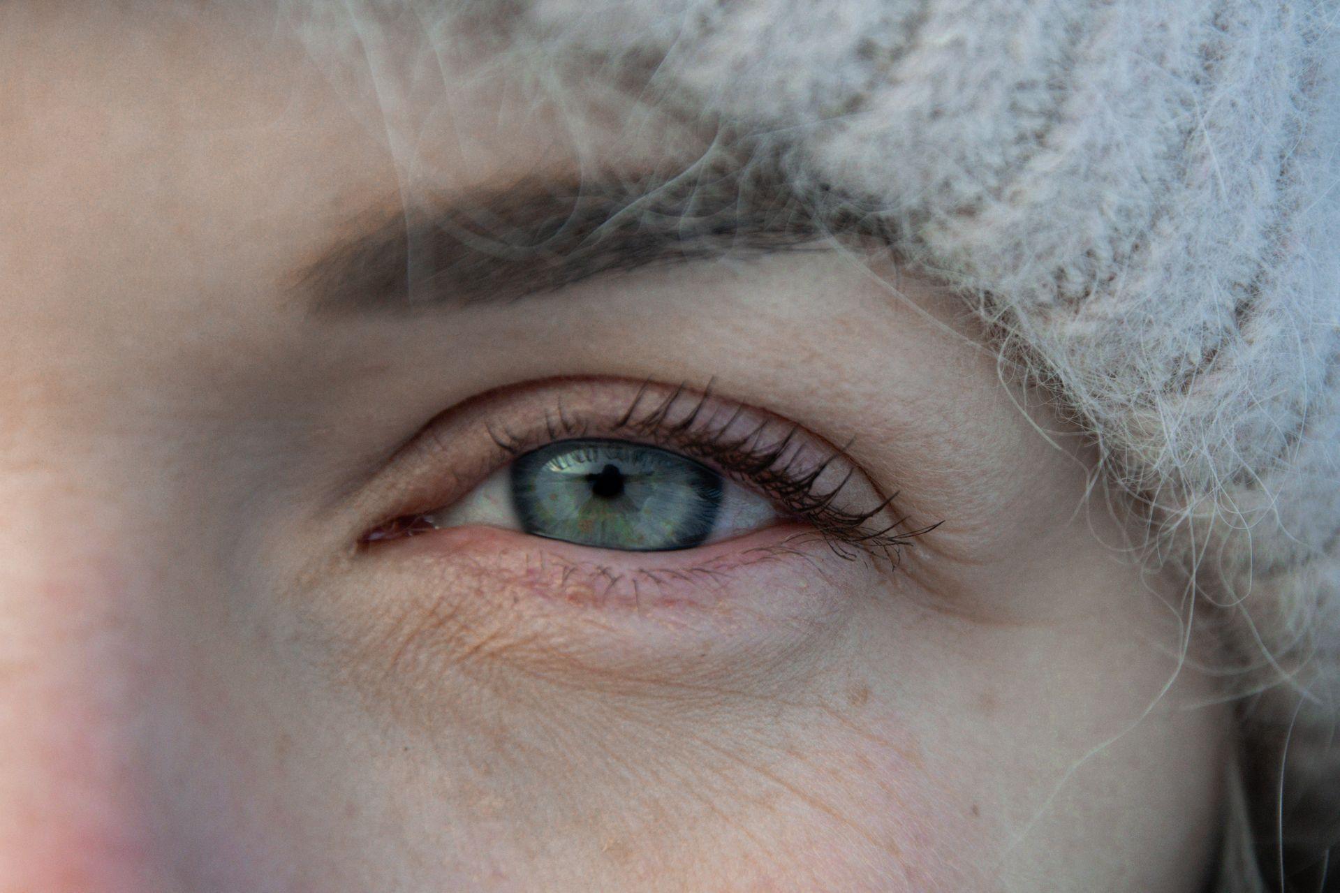 an eye of a woman with droopy eyelids