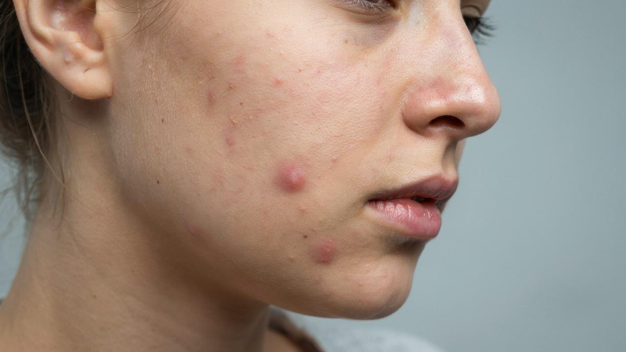 Deep acne nodules creating raised bumps under the skin.