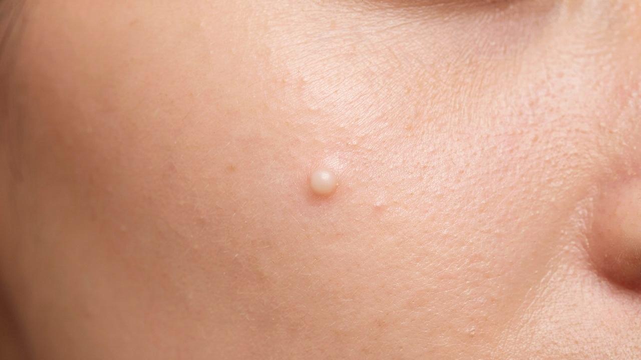 Close-up of a whitehead on facial skin.