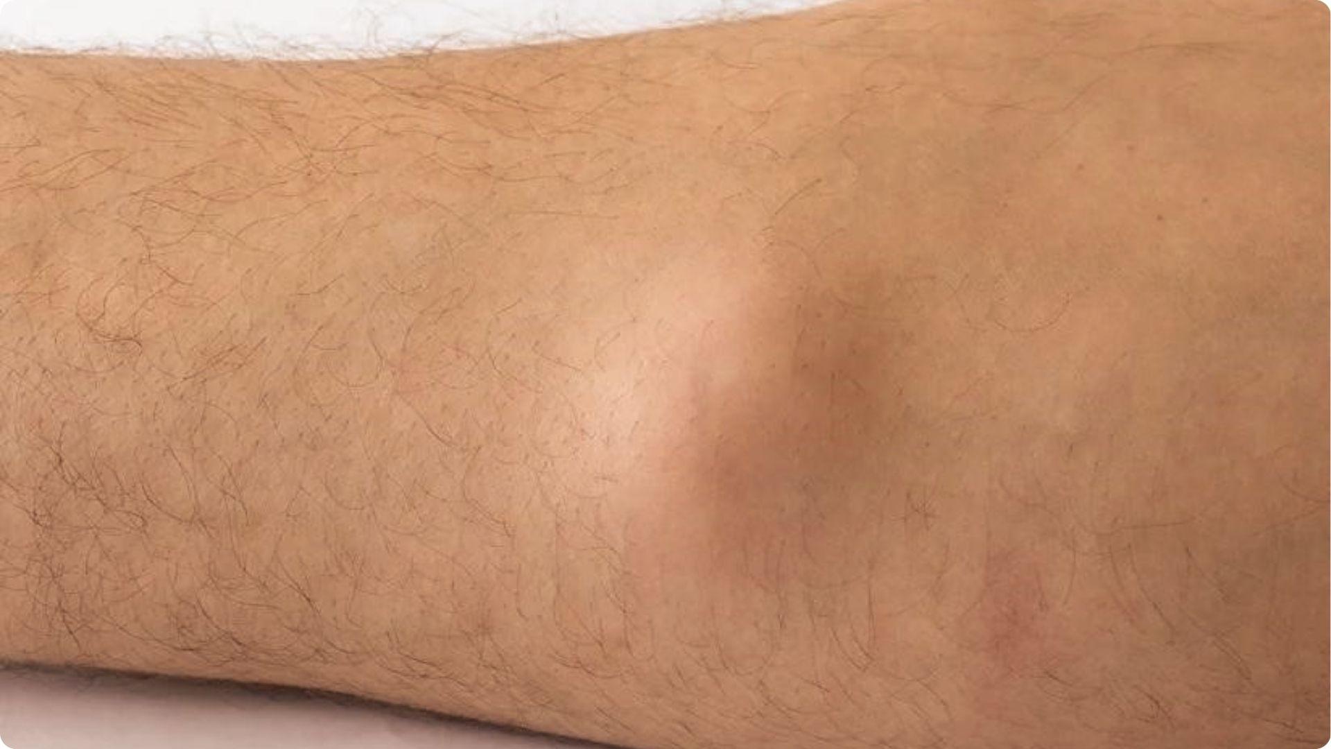On a hand showing Lipomas (Fatty Tumors) growth.