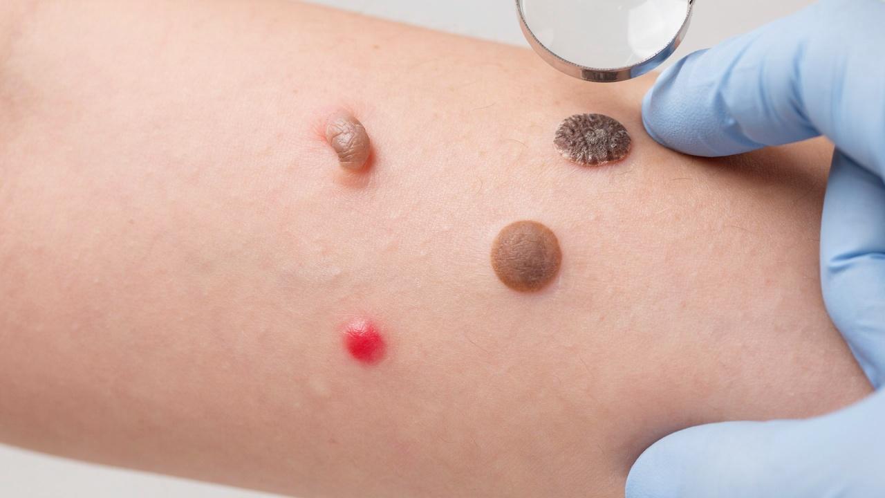 Close-up of healthy skin with several common benign skin growths being examined by a dermatologist.