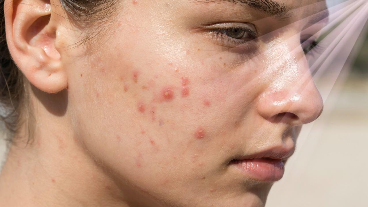 Sunlight affects acne-prone skin by increasing irritation and oil production.