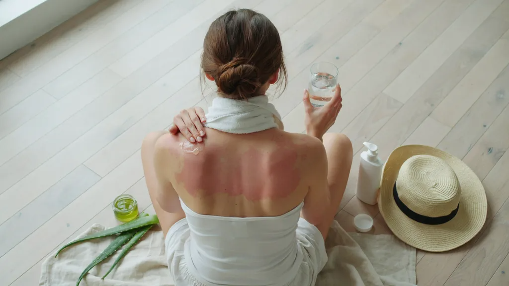 Person treating severe sunburn indoors with aloe vera, water, and a cool compress after sun exposure.