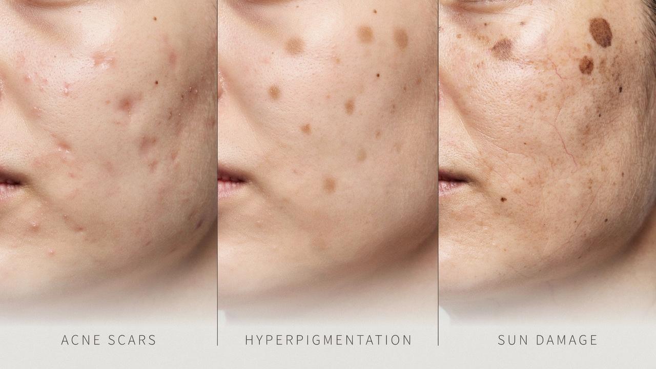 Acne scars and dark spots becoming worse after repeated sun exposure.