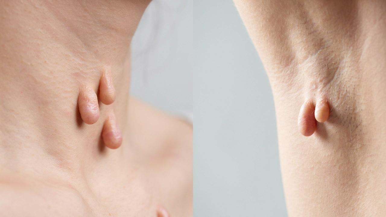 Close-up of soft, flesh-colored skin tags on the neck being examined in a dermatology clinic.