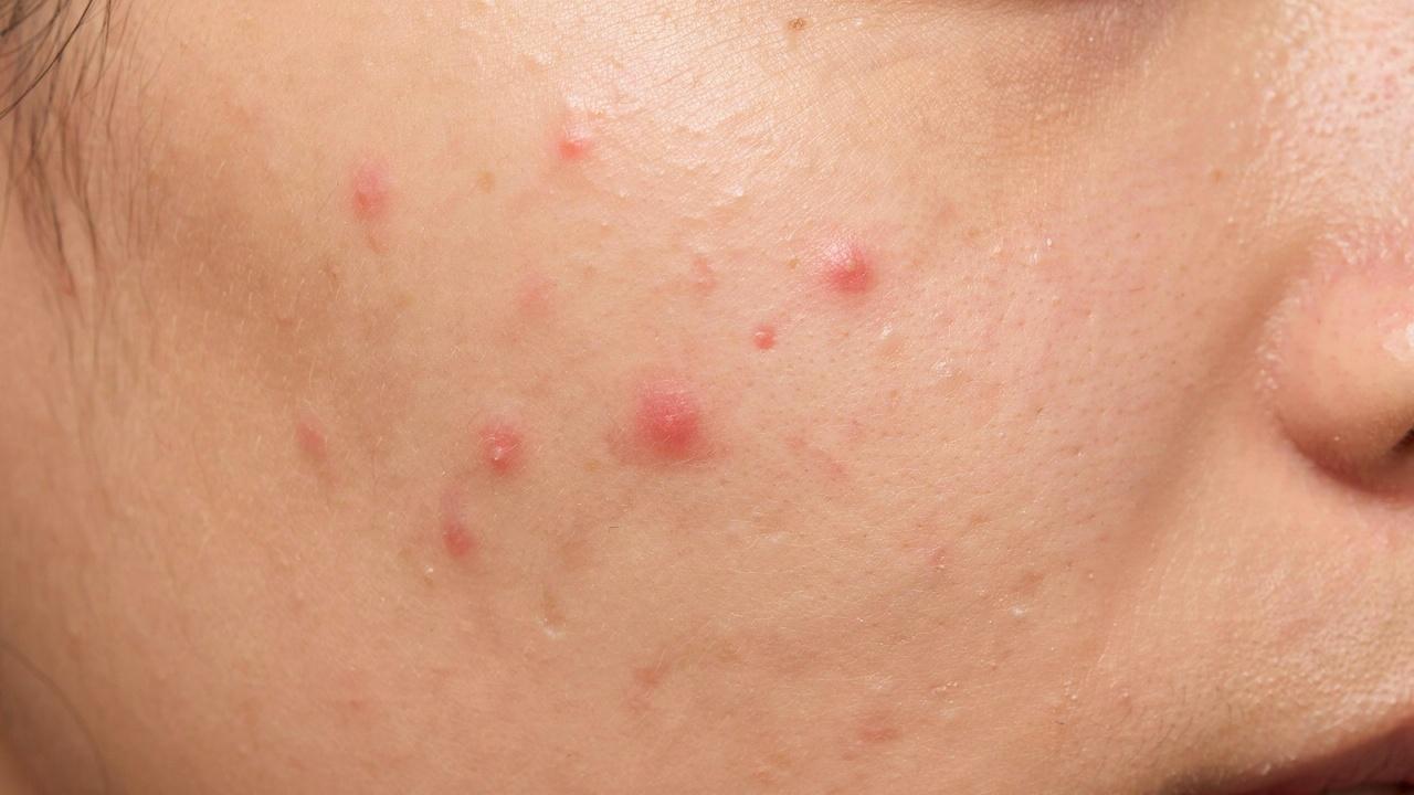 Small red papules on facial skin.