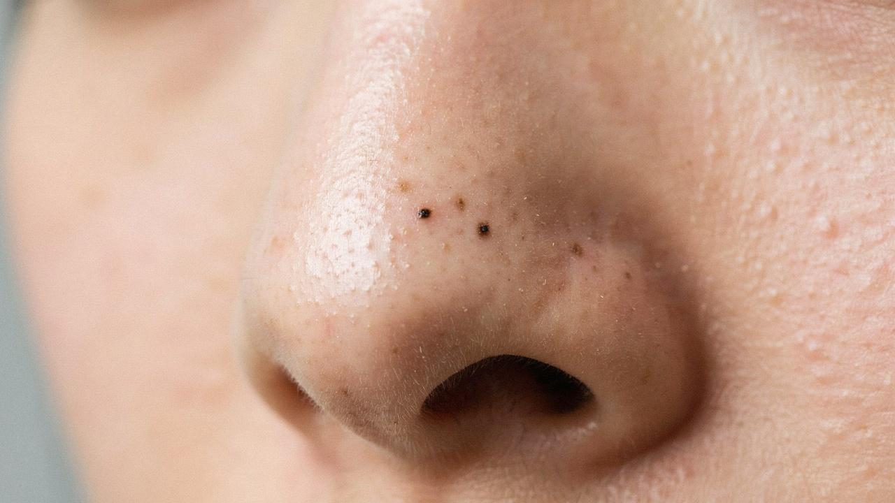 Blackheads visible on the nose in a close-up view.