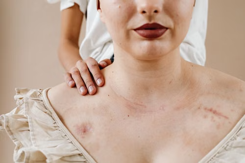 4 Ways to Dealing With Visible Scars After Rideshare Crash