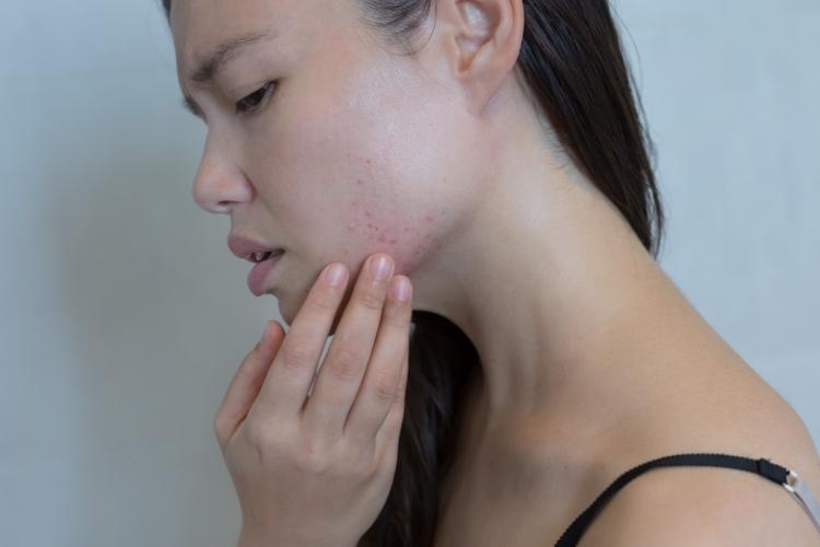 Skin Keep Breaking Out?
