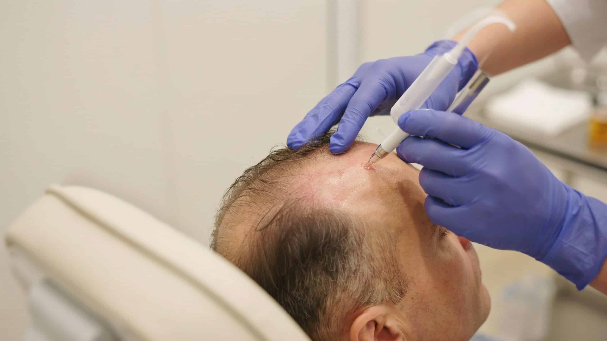 Is Scalp Microneedling Effective for Hair Loss?